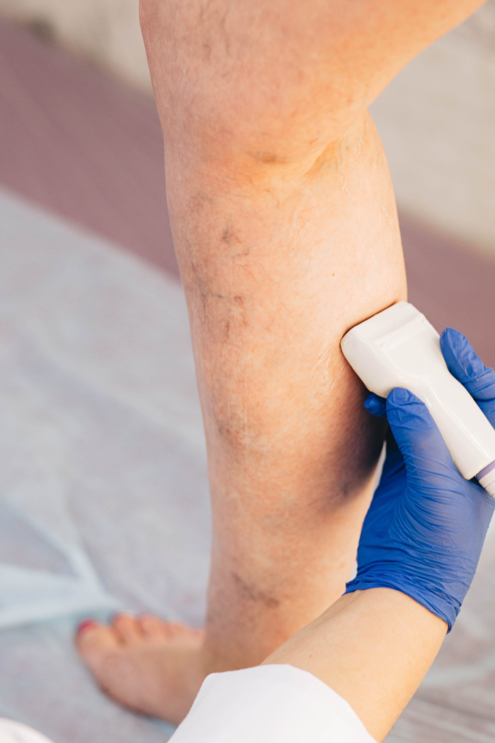 Tratamento de Varizes, Trombose e Doenças Vasculares em São Paulo