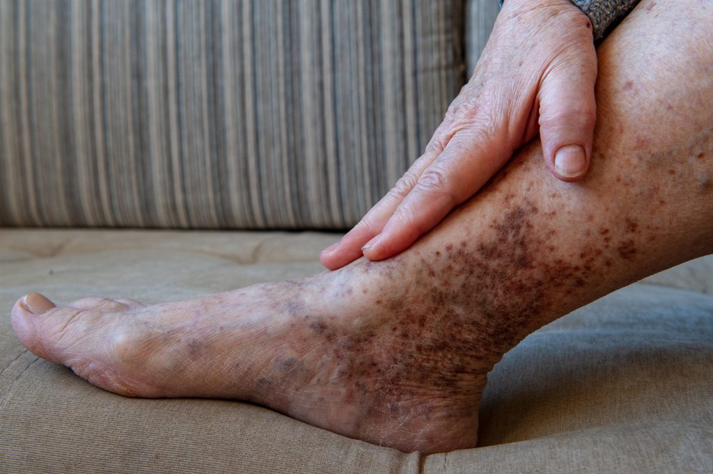 erisipela doutor luis dotta