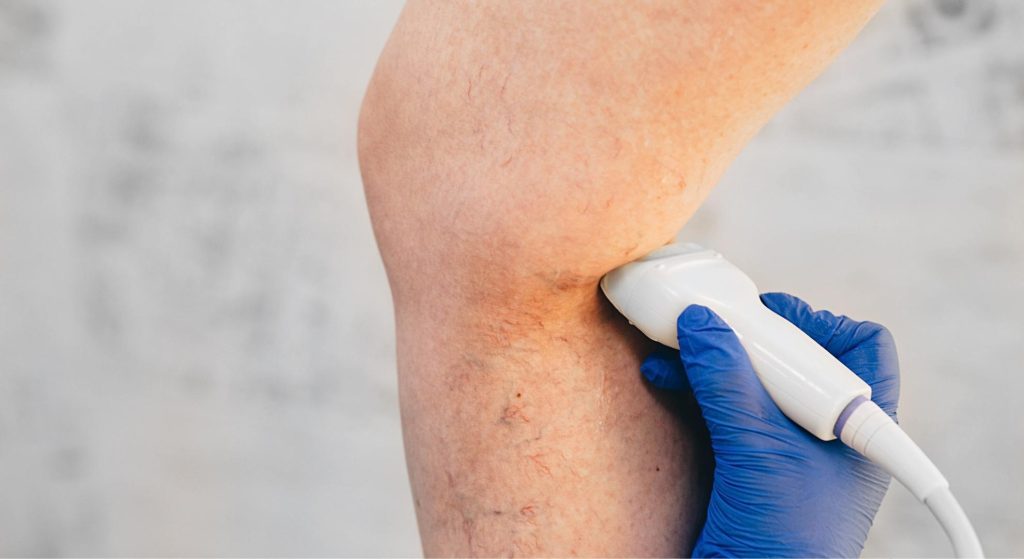 Doppler doutor varizes