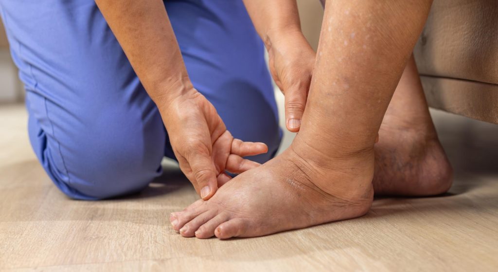 inchaço nas pernas doutor varizes